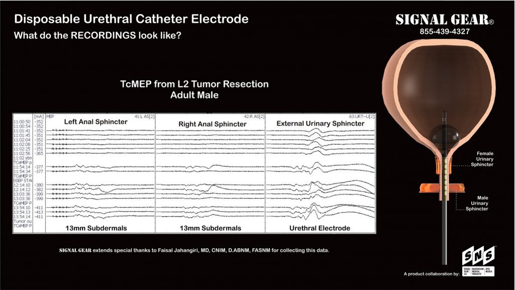 Elétrodo Bipolar Catéter Uretral Ouro 16Fr 200cm TP