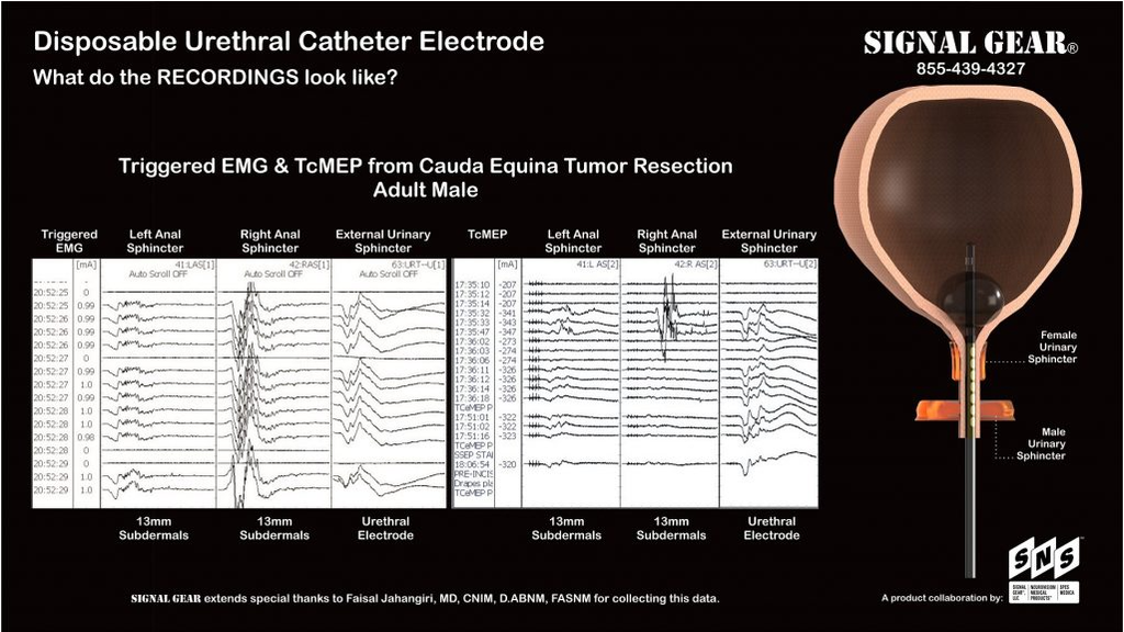 Elétrodo Bipolar Catéter Uretral Ouro 16Fr 200cm TP